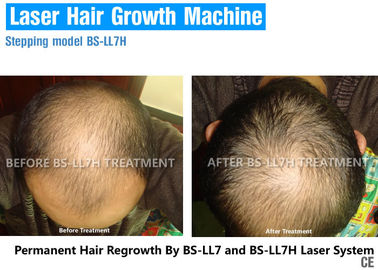 Низкоуровневая терапия лазера для роста волос